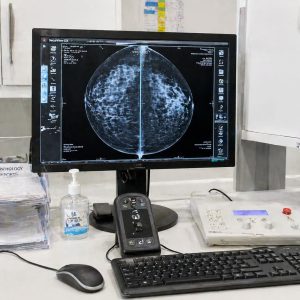 Risk-reducing mastectomy: making the decision if you carry a high-risk gene