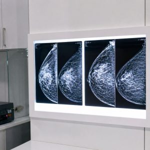 Why some people need a second operation after a lumpectomy. Re-excision explained